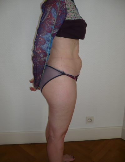 photos liposuccion avant opération