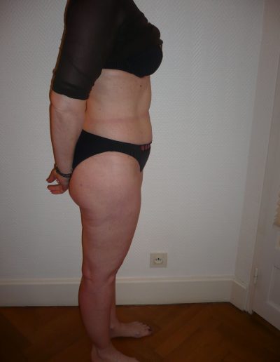photos liposuccion après opération