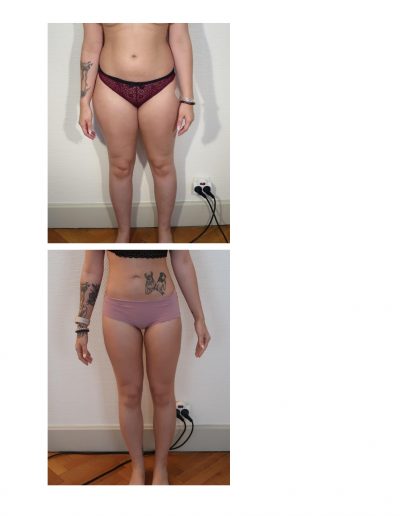 photo lipoaspiration avant après