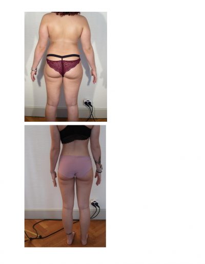 photo lipoaspiration avant après