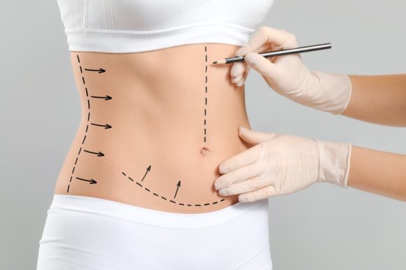 Lipoaspiration VASER : Un procédé novateur pour éliminer la graisse tenace