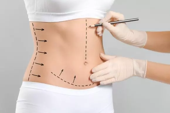 Lipoaspiration VASER : Un procédé novateur pour éliminer la graisse tenace